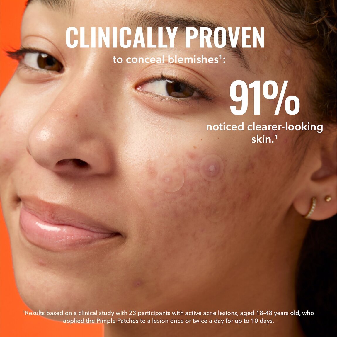 pimple-patches-b0 zb_p.jpg