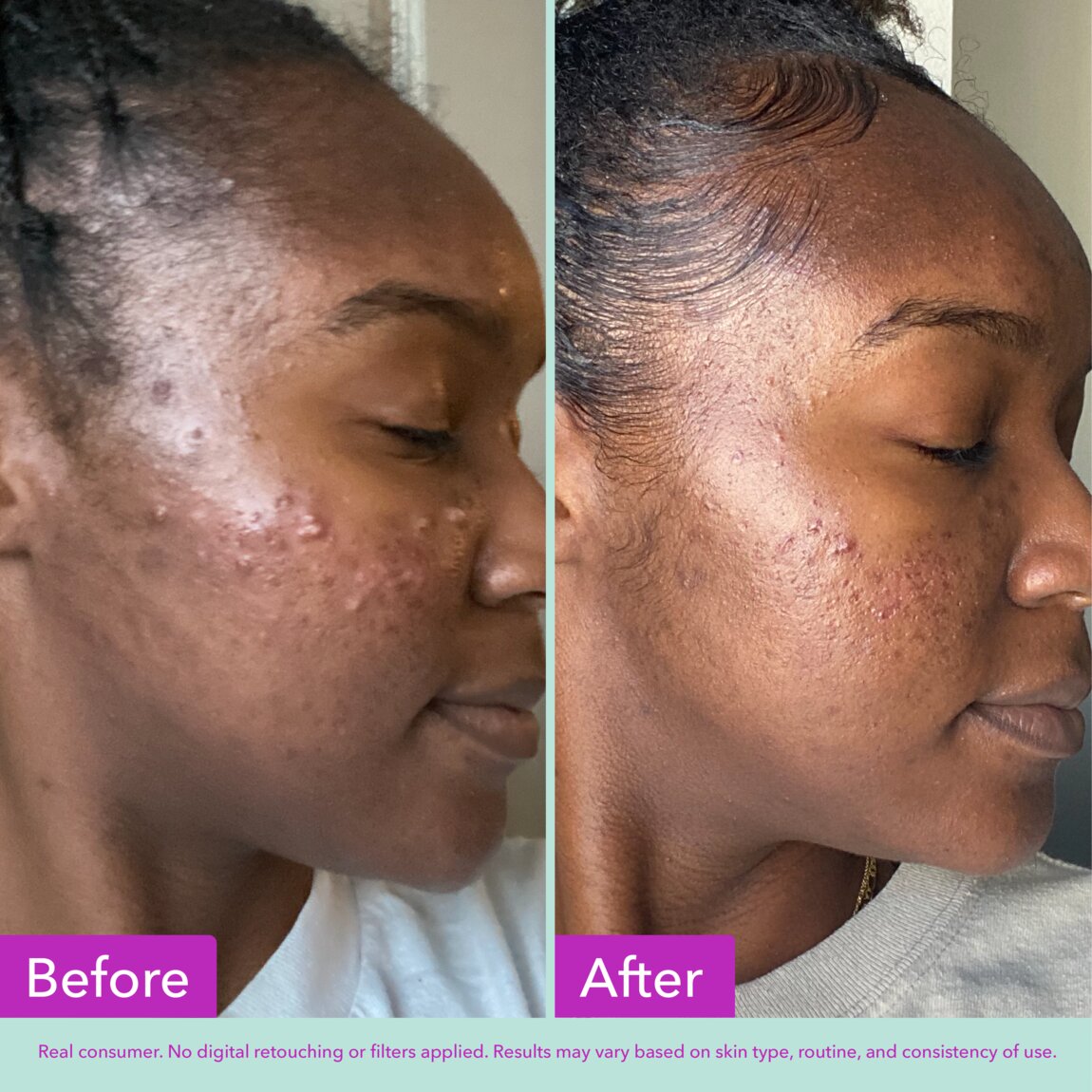 acne-foaming-cleanser-s3 zb_p.jpg